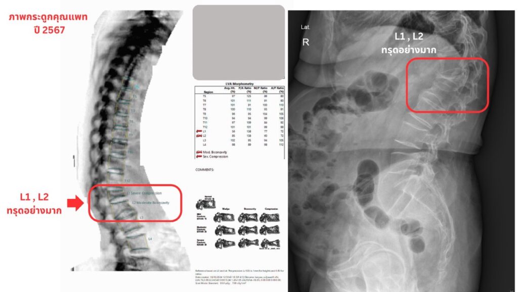 ภาพ x-ray พบกว่า กระดูกสันหลังทรุด จนปวดหลังอย่างมาก นอนไม่ได้เลย